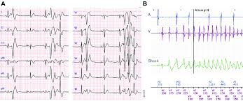 Are those ventricular premature contractions really benign? The Occurrence Of Premature Ventricular Contractions Pvcs And Download Scientific Diagram