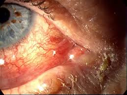 Image result for Gonococcal Conjunctivitis