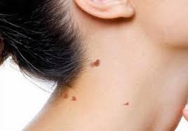 Image result for skin warts images hd free
