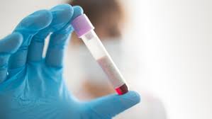 Wer eine menge an zeit bezüglich der untersuchungen auslassen will, möge sich an die genannte empfehlung in unserem cholesterin ab wann. Hohe Cholesterinwerte Richtig Behandeln Ndr De Ratgeber Gesundheit