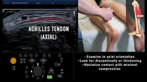 We did not find results for: Ultrasound Tutorial Msk Series Achilles Tendon Radiology Nation Youtube