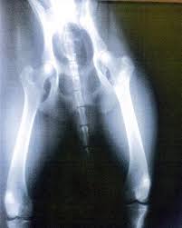 Primary bone cancer originates from the bone, and metastatic bone cancer originates from a cancer in another part of the body, but have spread to the bone. Bone Tumor Diagnosis Devastating But Common The Blade
