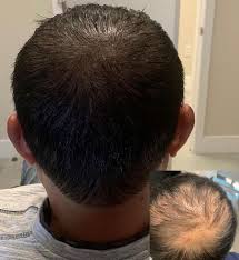 Redness and irritation on the scalp ; How Scalp Micropigmentation Can Give You Fuller Hair Seattle Met