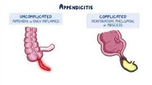 Image result for Appendicitis