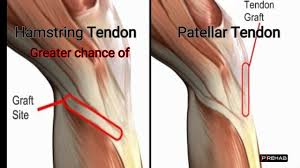 Acl Graft Options Include Your Own Tissue Autograft Or Tissue From A Donor Allograft For Autografts Tissue Can Be Taken From Many Grafting Acl Hamstrings