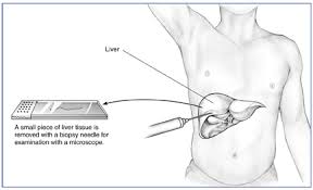 The tissue is generally examined under a microscope by a pathologist; Liver Biopsy Niddk