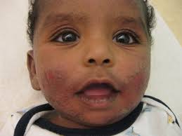 Image result for ekzema face