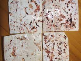 People with this disease also report feeling crawling, stinging. Morgellons Disease Dermnet Nz