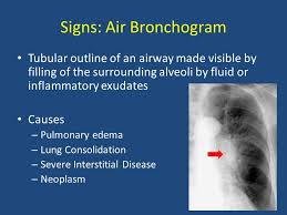 Image result for Air Bronchogram