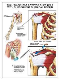 Rotator Cuff Exercise To Strengthen Your Shoulders And Prevent Shoulder Injuries Rotator Cuff Exercises Rotator Cuff Tear Rotator Cuff Surgery