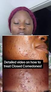 Closed Comedone is one of the most sturbon achne to understand or trea...