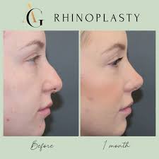 Dr Griffin is a specialist ENT, Head & Neck Surgeon (MED0001664079) with  substantial experience in Facial Plastic Surgery consulting in Brisbane,  Australia. For appointments or enquiries click link in bio. ….