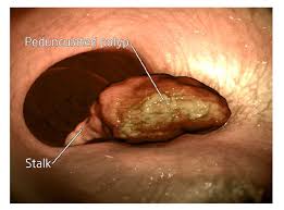 The polyps are removed from posterior to anterior direction. Advanced Polypectomy For Large Polyps Hull University Teaching Hospitals Nhs Trust