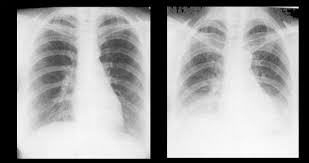 Poland syndrome has an erratic occurrence and usually affects the right side of the body. Mbbs Doctors Basics Of Reading Chest X Ray X Ray Medical Studies Radiology Technologist