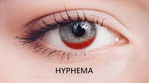 Image result for Hyphema