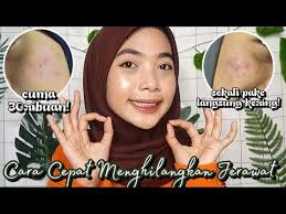 Cara menghilangkan jerawat secara alami. Pin Di Watch Ok