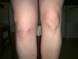 Vor Vier Wochen Kniespiegelung Ist Es Normal Dass Das Knie Immer Noch Nicht Voll Beweglich Ist Und Anschwillt Gesundheit Medizin