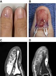 Image result for Glomus tumor
