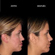 Cirugía Ortognática Mínimamente Invasiva⁣⁣⁣⁣⁣ ⁣⁣⁣ 👩🏻‍⚕️⁣ Ortodoncia a  cargo de Dra. Laura Andrada (@dralauraandrada)⁣⁣⁣ ⁣ 🦷 La paciente sufría  una deformidad dentofacial, que fue corregida exitosamente a través de un  triple procedimiento