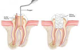 What if i don't do the root canal? To Live Or Let Die Root Canal Vs Extraction Green Valley Dentistry