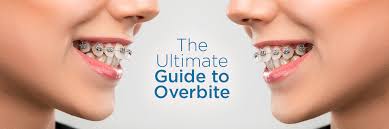 The use of adjunctive intraoral appliances. Guide To Overbite Causes Symptoms And Treatment Options