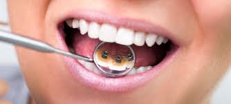 「lingual orthodontics」の画像検索結果
