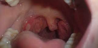 What facts should i know about oral cancer (throat and mouth cancer)? Patients With Mouth And Oesophageal Cancers Take Longer To Seek Help From Gp University Of Cambridge