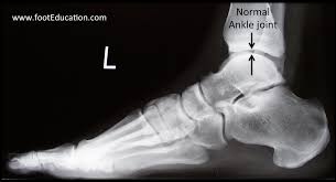 Image result for Ankle XRay