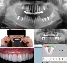 Apakah bahasa spanyol adalah bahasa bernyanyi yang indah? Complete Arch Fixed Reconstruction By Means Of Guided Surgery And Immediate Loading A Retrospective Clinical Study On 12 Patients With 1 Year Of Follow Up C Tech Implant Implan Gigi Mini Dan Implan
