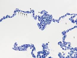 Blood air barrier) details zum aufbau der schranke finden sich hier. Histologie Lungen Gewebe Alveolen Makrophagen Blut Luft Schranke
