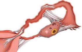MenstruaÈ›ia NeagrÄƒ Cauzele ApariÈ›iei Cum SÄƒ Scapi De Ele Cauzele Sangelui Lunar Intunecat Care Este Pericolul DecolorÄƒrii Cu MenstruaÈ›ie DescÄƒrcare De Intuneric