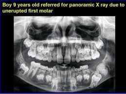 Dentaltown Boy 9 Years Old Referred For Panorex X Ray Due To Unerupted First Molar A Complex Odontoma Also Cal Dental Hygiene School Dental Humor Dentistry