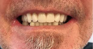 Maybe you would like to learn more about one of these? Before After Denture Pictures New Westminster Denture Work