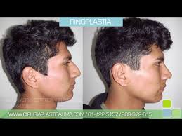 Rinoplastia Hombres Lima Peru