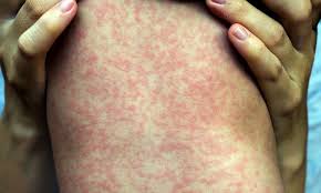 Image result for Measles