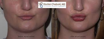 The soft tissues of the lips are sensitive to trauma and frequently swell significantly when injured, even from a slight bump on the lip 1.fortunately, treatment for a swollen lip due to an injury is relatively simple. How To Reduce Swelling After Lip Injections And Botox