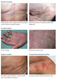 Image result for scabies in the groin area