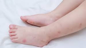 Totul Despre Intepaturile De Insecte La Copii Sfatul Miculrinocer Ro