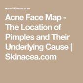 Acne Face Map The Location Of Pimples And Their Underlying Cause Skinacea Com Face Acne Acne Mapping