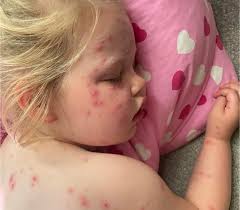 Abbey Hunt “Hello I just thought you might like to see my daughters results  from having horrendous chickenpox and using your green cream. Won't lie she  was a trooper though the whole