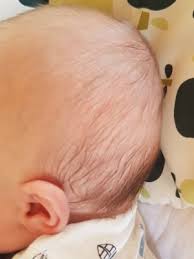 Ein platter hinterkopf beim baby kommt häufig davon, dass die kleinen so oft auf dem rücken liegen. Kopfverformung Marz 2017 Babyclub Seite 2 Babycenter