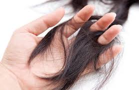 Rụng tóc do thiếu máu thiếu sắt? | Vinmec