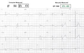Long Qt Syndromes And Torsade De Pointes The Cardiology Advisor