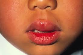 Allergic Reaction Swollen Upper Lip Of A Six Year Old Boy Who Is Experiencing An Allergic Reaction To Peanuts Eating P Lip Allergy Swollen Lips Food Allergies
