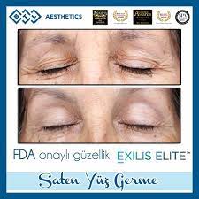 Saten Yuz Germe Islemi Dunyada Periorbital Wrinkle Reduction Goz Kapagi Ve Cevresindeki Kirisikliklarin Tedavisini Klinik Calismalar Il Yuzler Kolajen Gozler