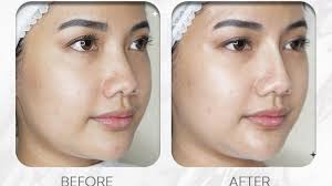 √TANAM BENANG HIDUNG: CARA INSTAN MEMBUAT HIDUNG MANCUNG TANPA OPERASI!