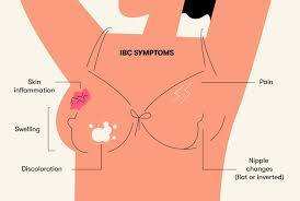 Image result for Inflammatory breast cancer