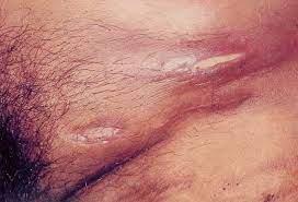 Туберкулез кожи индуративный (tuberculosis cutis indurativa). Https Citeseerx Ist Psu Edu Viewdoc Download Doi 10 1 1 175 4340 Rep Rep1 Type Pdf