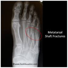 Image result for Metatarsal