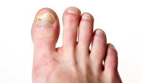 Usted será superado por la voluntad y el carácter de otro. Catalogo De Marcas De Crema Para Hongos En Los Pies Para Comprar Online Elmaquillajeesmipoder Es